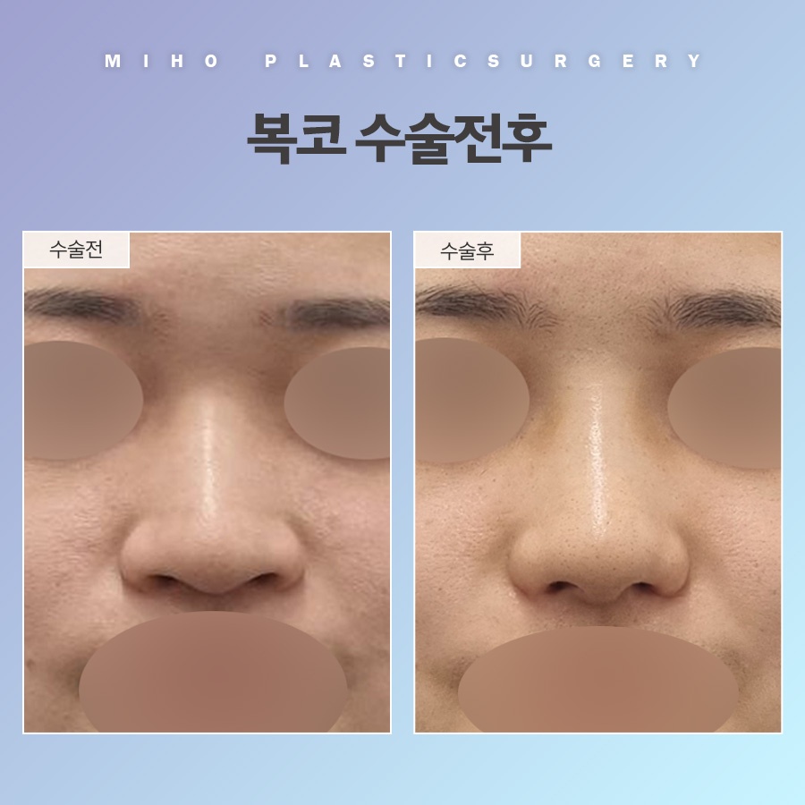 복코 교정 관상까지 좋아지려면 관련 이미지 8