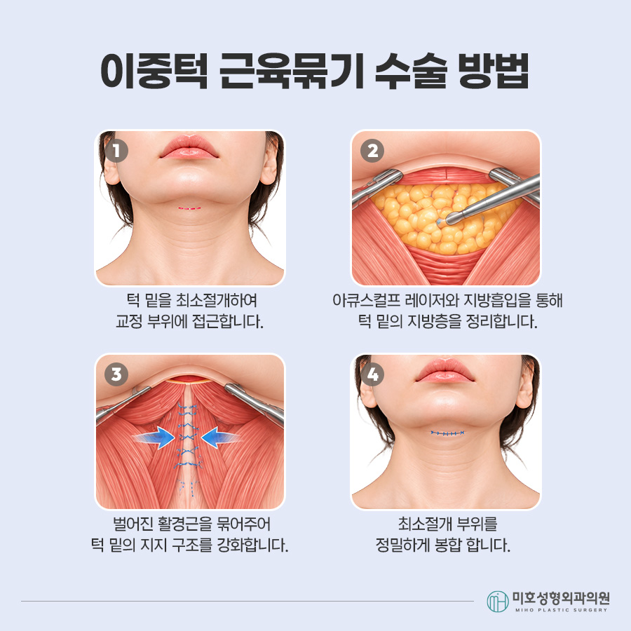 이중턱묶기란? 지방흡입과 차이부터 적합한 경우, 회복 과정까지 관련 이미지 6