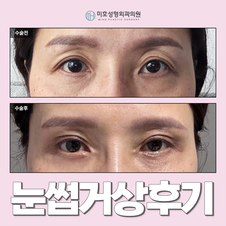 눈썹거상후기 속 주인공이 되는 법 관련 이미지 1