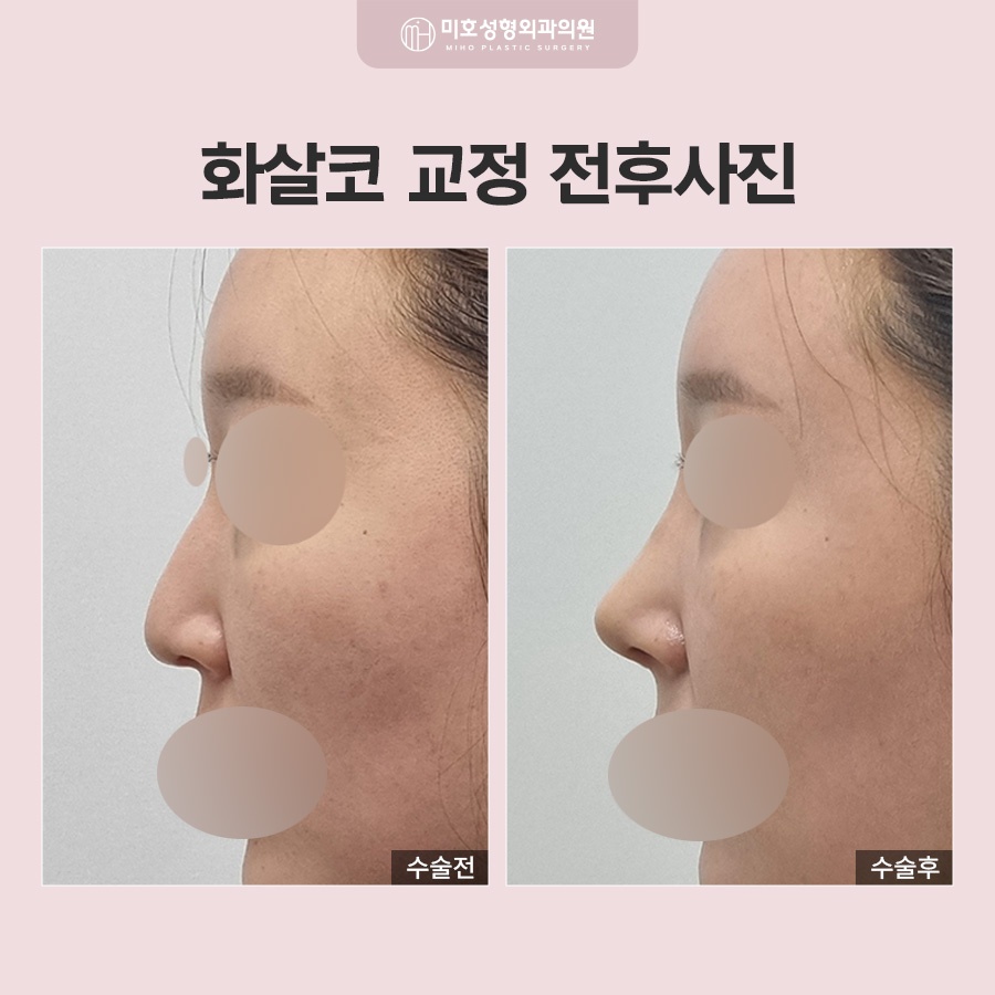 화살코 형태의 원인과 개선 방법 관련 이미지 8