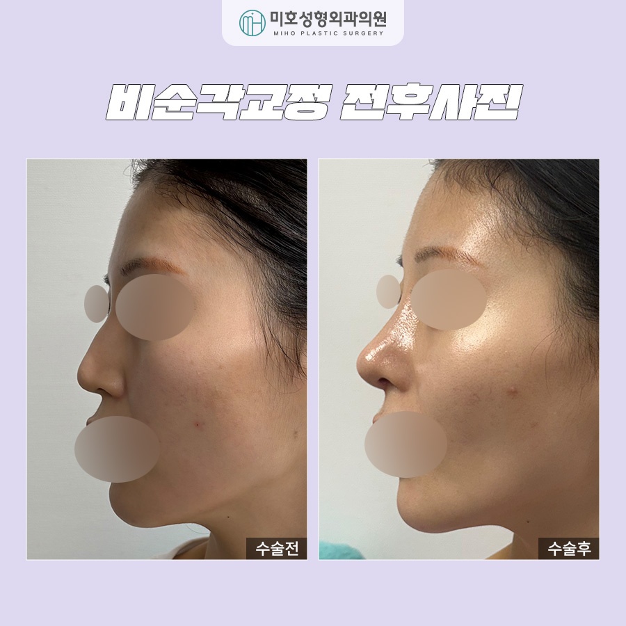Nasolabial Angle Correction: Who Needs It and How Should It Be Done? image 9