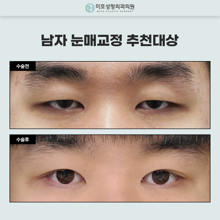 Naturally Defined Eyes with Male Eye-Shape Correction image 10