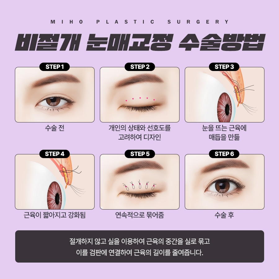The Key to a Natural Image Transformation with Male Eyelid Surgery image 4