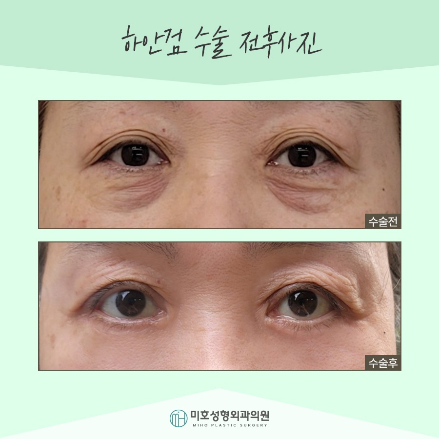 If Lower Blepharoplasty Is Needed for Drooping Eyes image 10