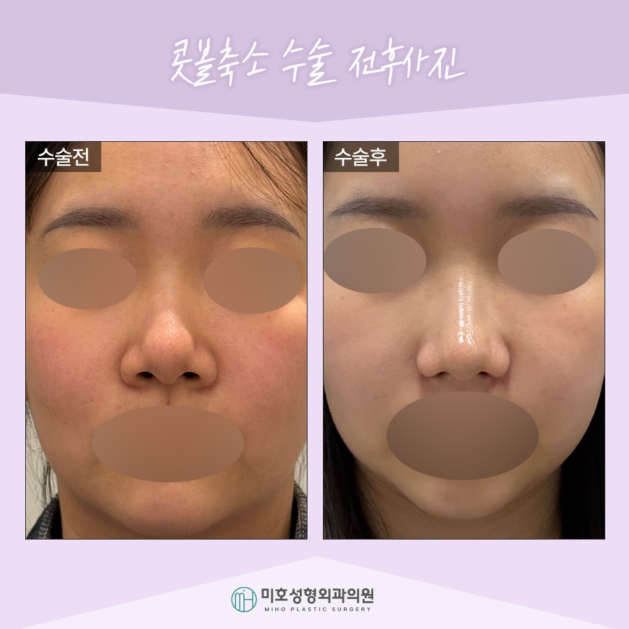 Nasal Alar Reduction in a Natural Direction image 7