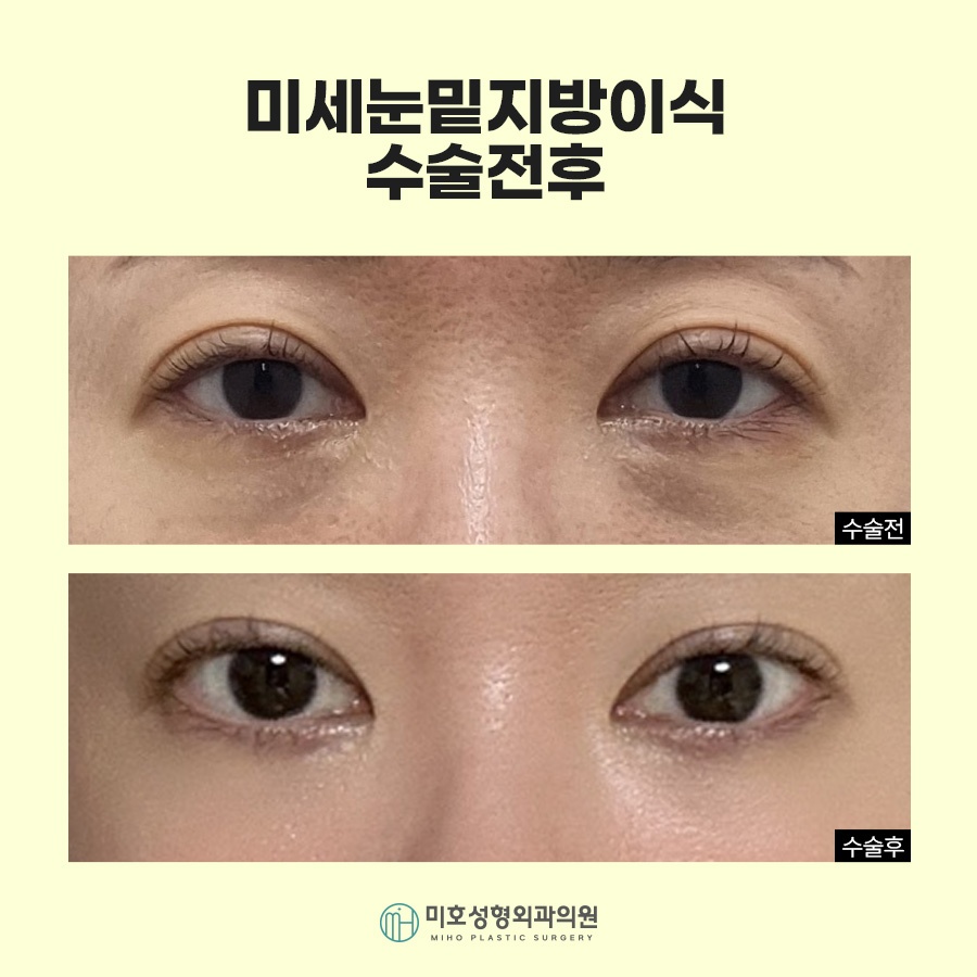 눈밑지방이식 자연스러운 입체감 완성 관련 이미지 10