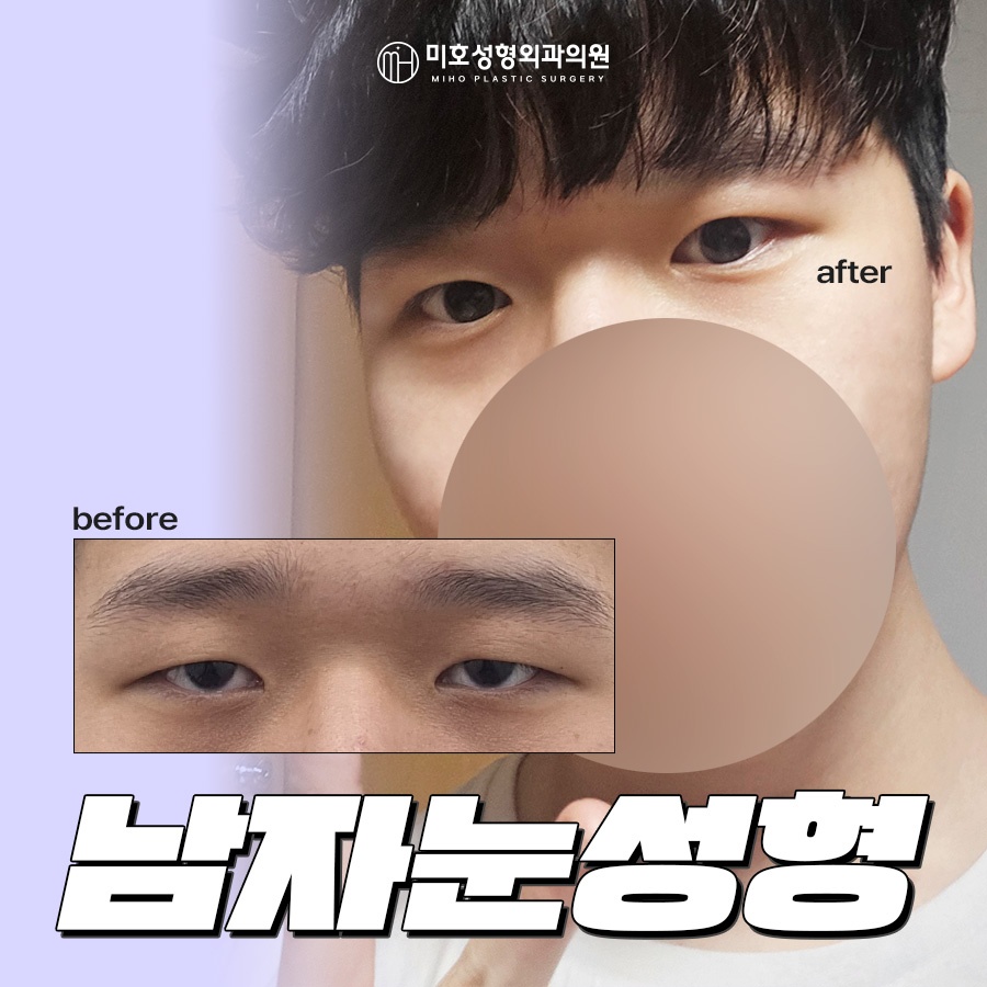 남자눈성형 무쌍눈매교정 특징 알아보기 관련 이미지 1