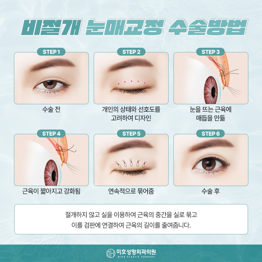 Natural-Looking Male Eye Shape Correction image 6