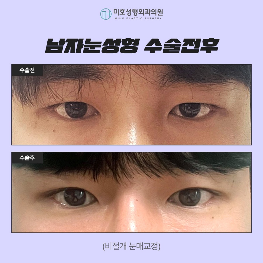 남자눈성형 무쌍눈매교정 특징 알아보기 관련 이미지 6