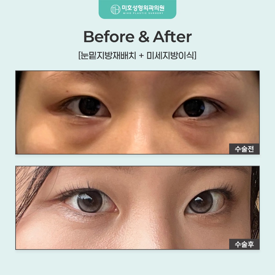 눈밑지방재배치 어두운 인상이 고민이라면 관련 이미지 9