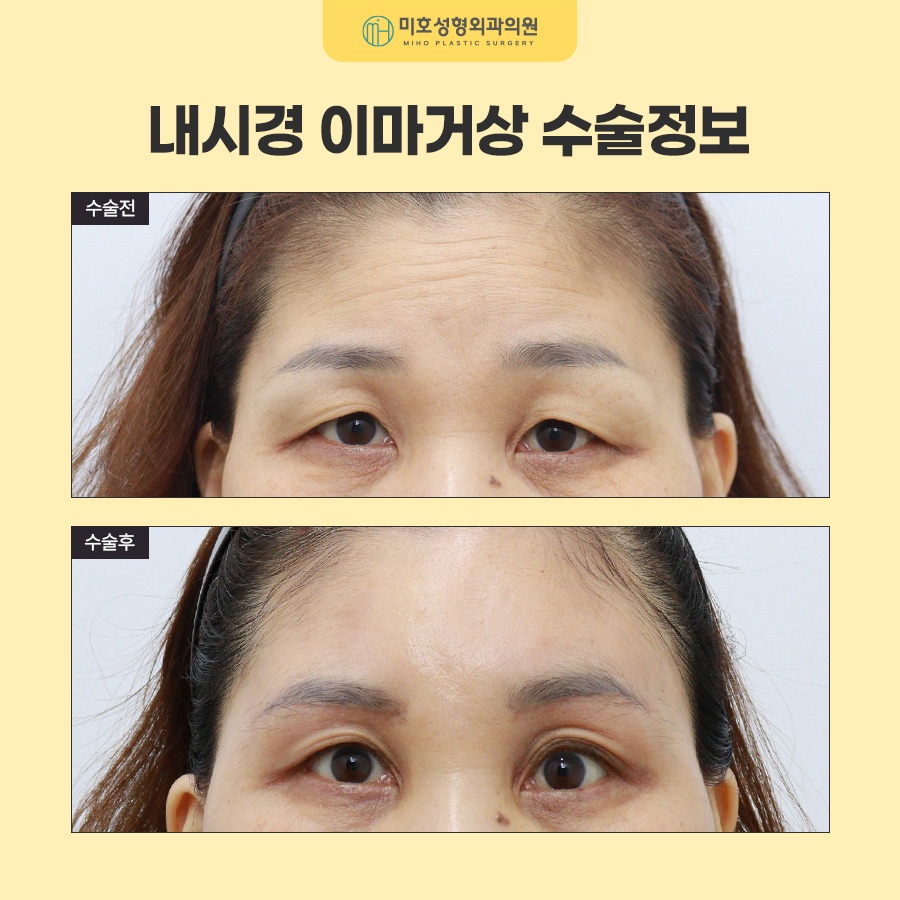 내시경이마거상 부기와 회복기간, 유지기간까지 알아보기 관련 이미지 9
