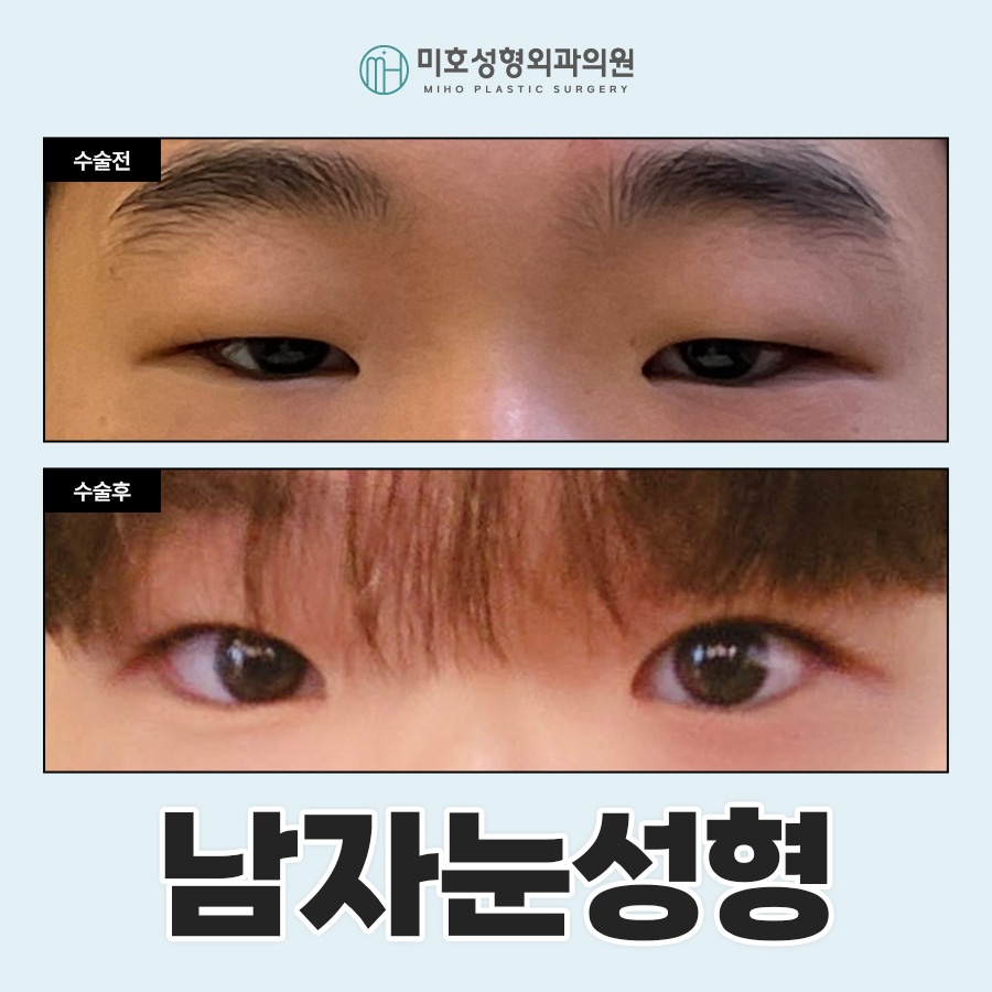 Focusing on a Natural Look in Male Eye Surgery image 1