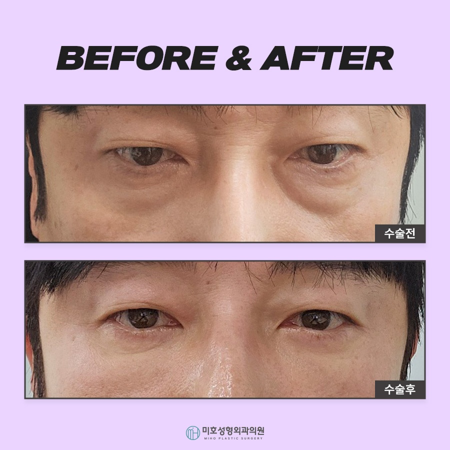 눈밑지방재배치로 젊음을 획득 관련 이미지 8