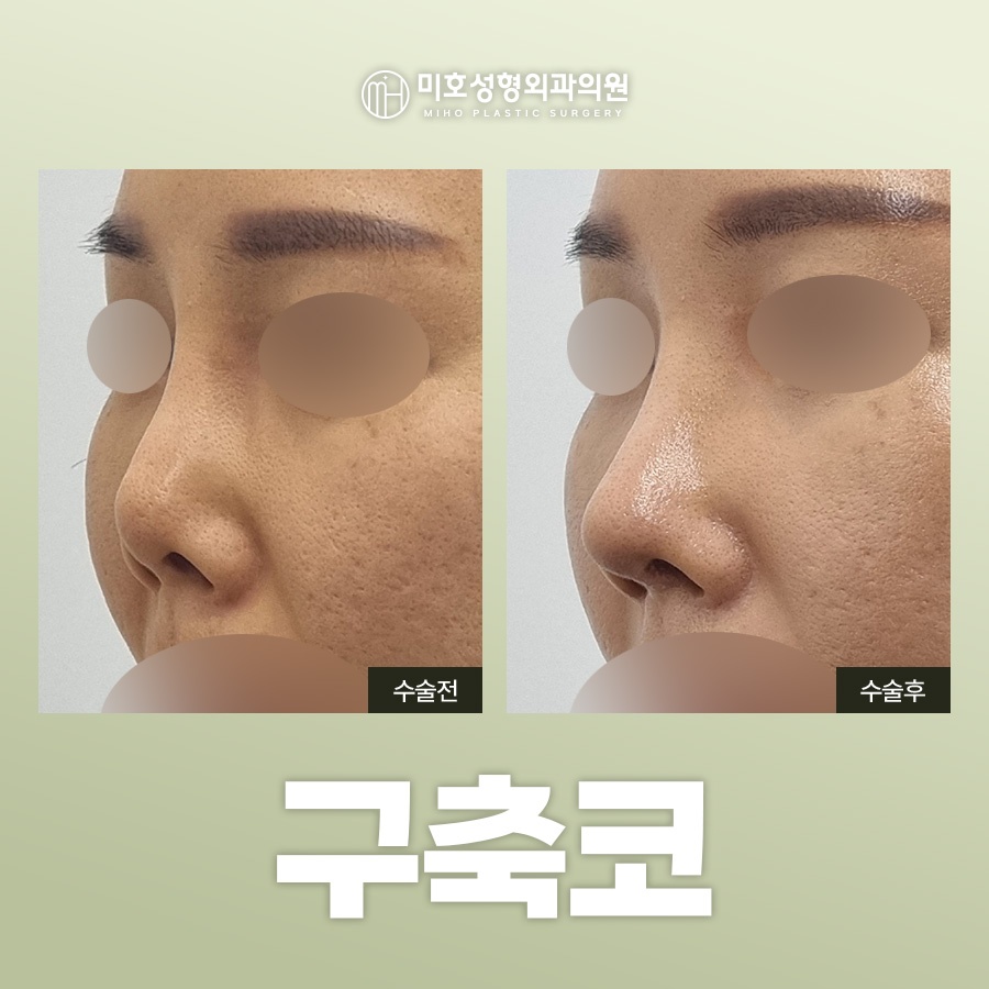 Identify the Cause of a Contracted Nose Before Attempting Revision image 1