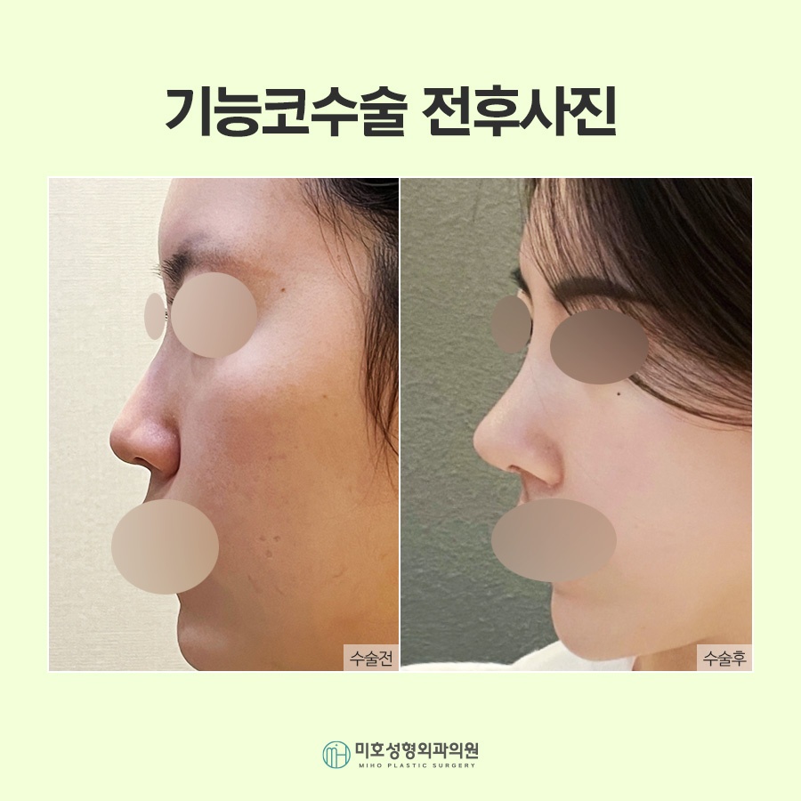 비밸브재건술 기능을 회복시키며 관련 이미지 8