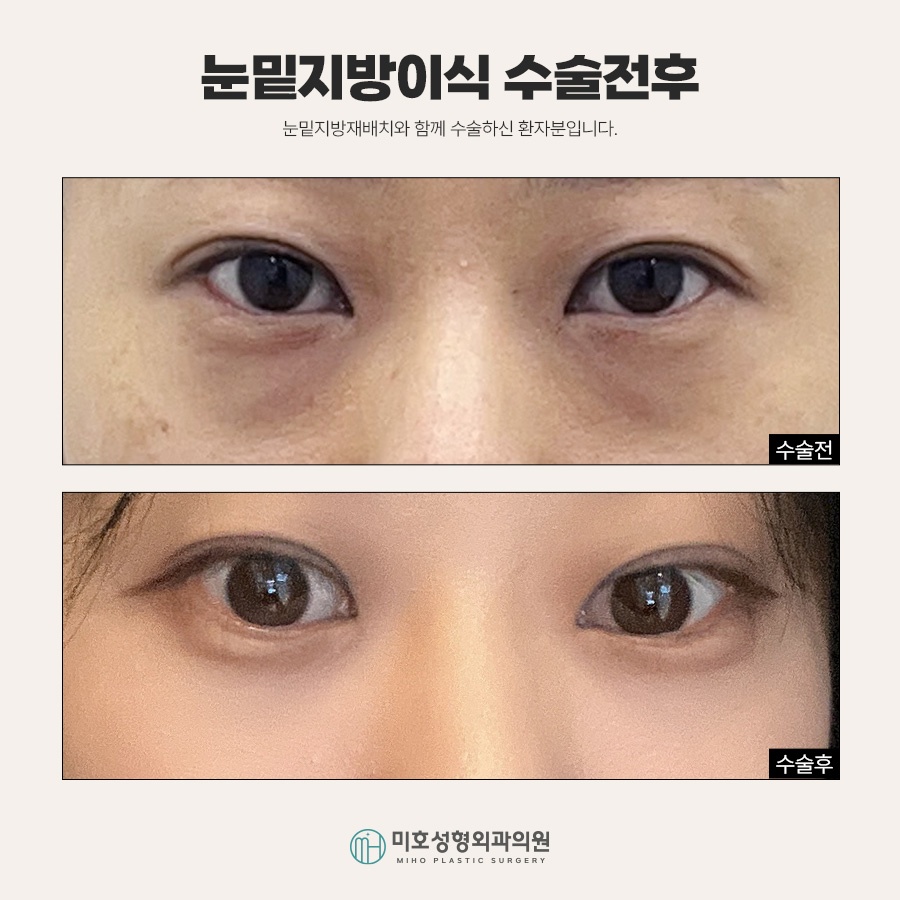 If Under-Eye Fat Grafting Is Stressful Because It Makes You Look Tired image 10