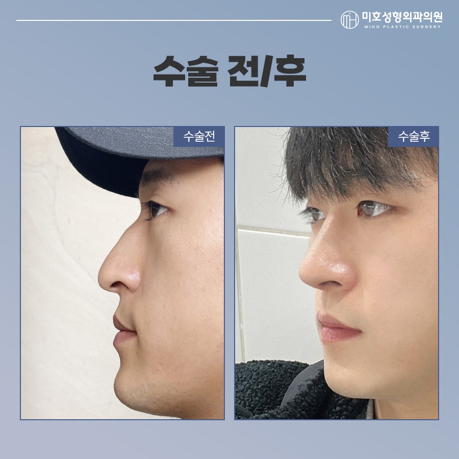 남자코 성별에 따른 차이점을 인지하여 관련 이미지 8