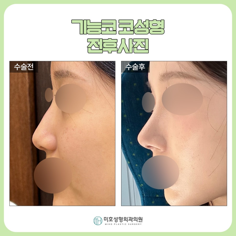 신논현코성형 선택시 고려할 부분들 관련 이미지 7