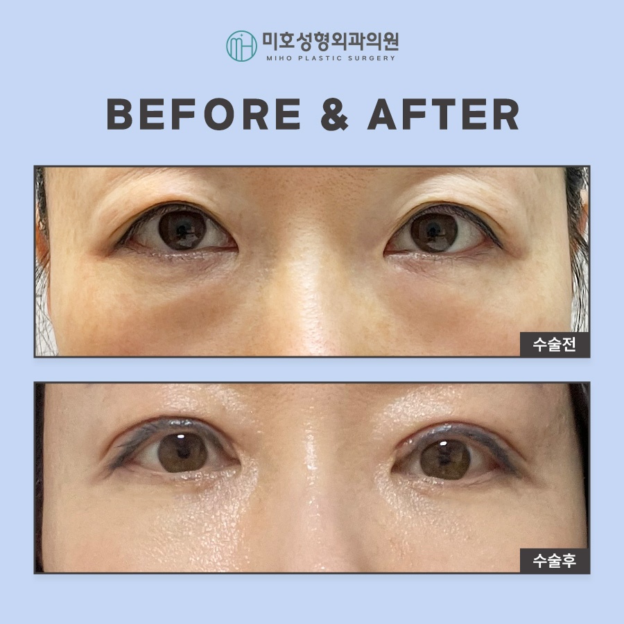 Miho Signature Lower Eyelid Fat Repositioning: The Beginning of Youth image 9
