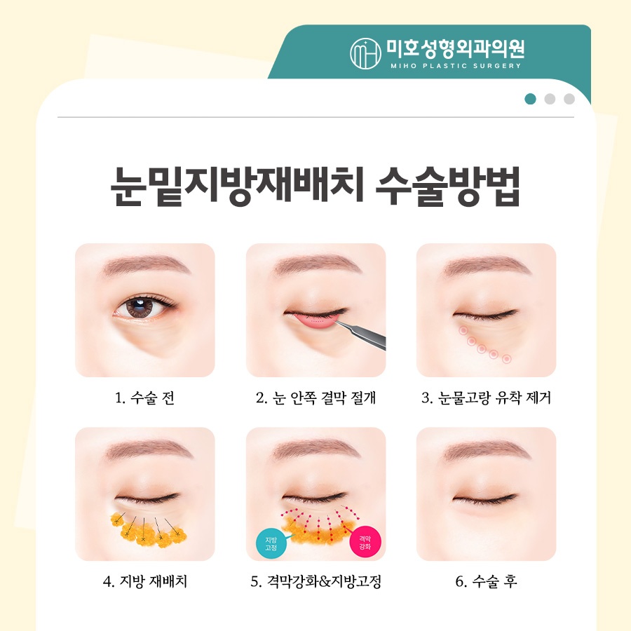 눈밑지방재배치 빠른 대처 방안 관련 이미지 5