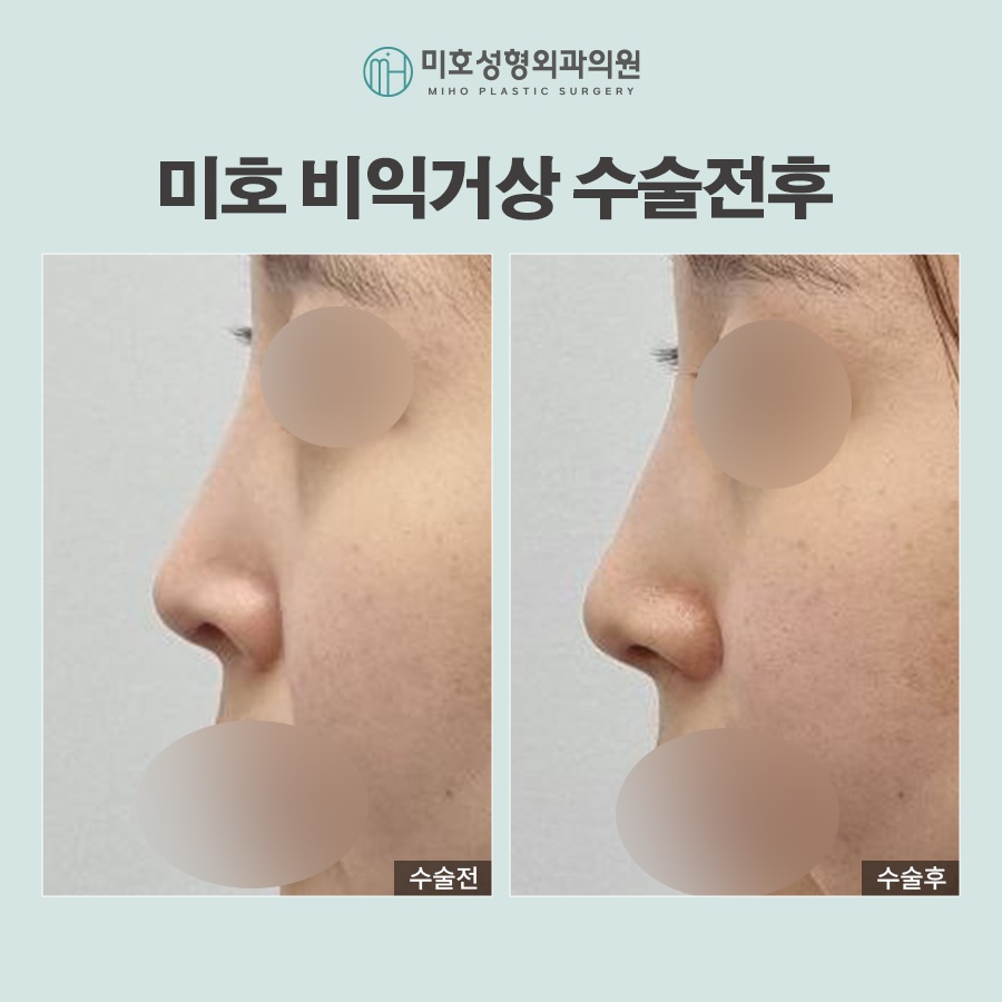미호 비익거상 자연스러운 콧날개올리기 비율교정! 관련 이미지 9