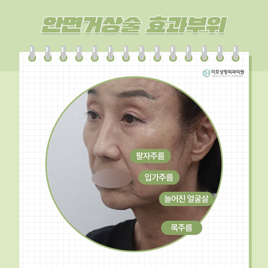 Wondering About the Side Effects of a Facelift? image 3
