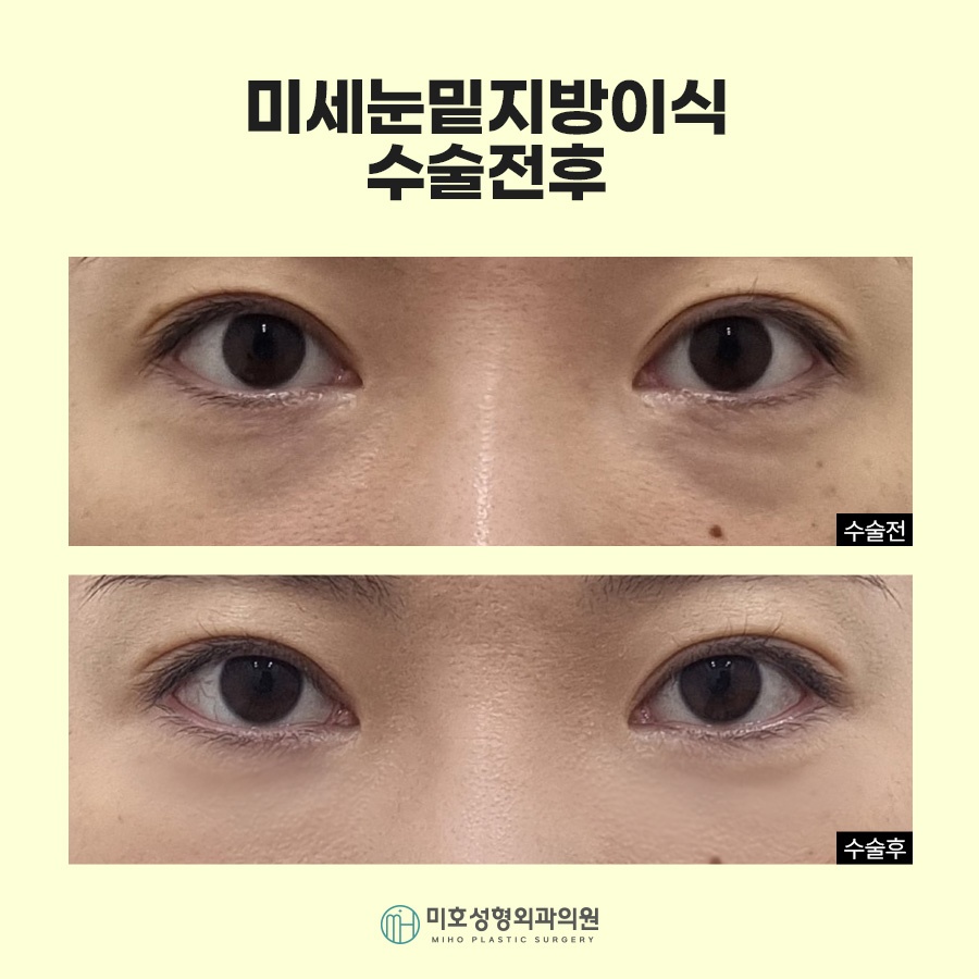 눈밑지방이식 자연스러운 입체감 완성 관련 이미지 8