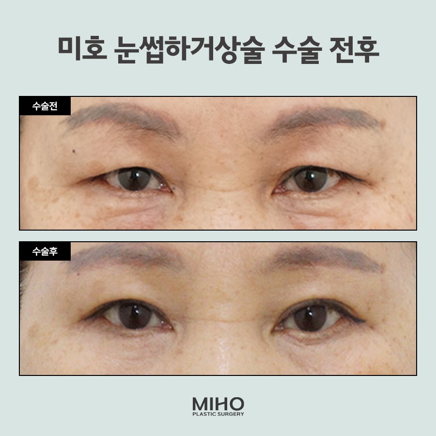 Sub-Brow Lift Scar, Cost, Recovery Process, Information, and Review image 9
