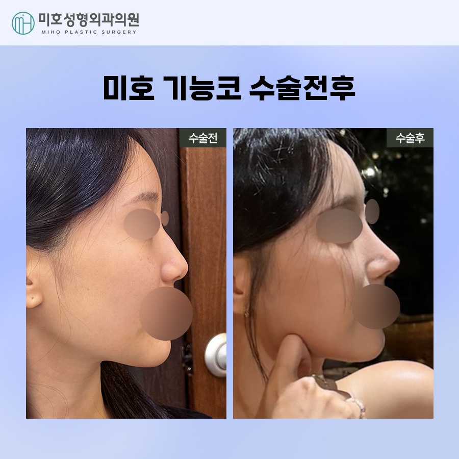 If You Are Looking for Ways to Improve Septal Deviation and Rhinitis Surgery image 8