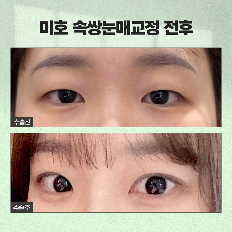속쌍눈매교정 또렷한 눈매를 원할때 관련 이미지 9