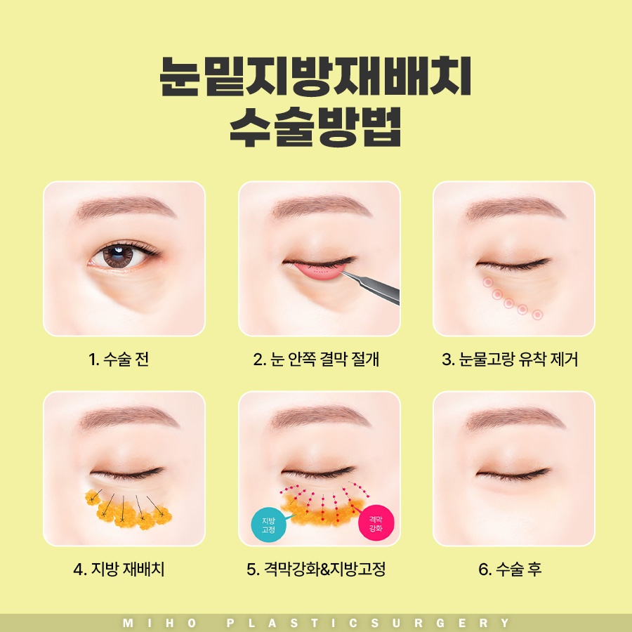눈밑지방재배치수술비용 내게 맞는 수준은 관련 이미지 4
