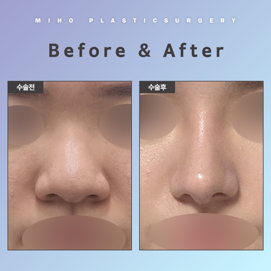 Natural-Looking Alar Reduction with Minimal Incisions image 10