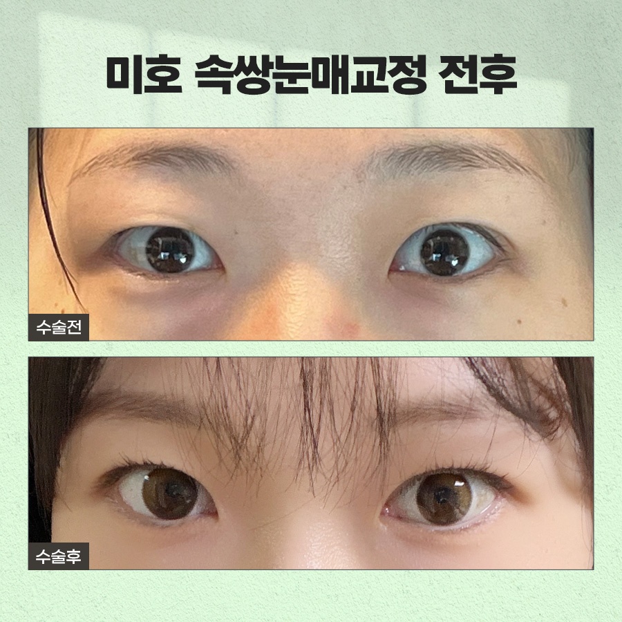 속쌍눈매교정 또렷한 눈매를 원할때 관련 이미지 8