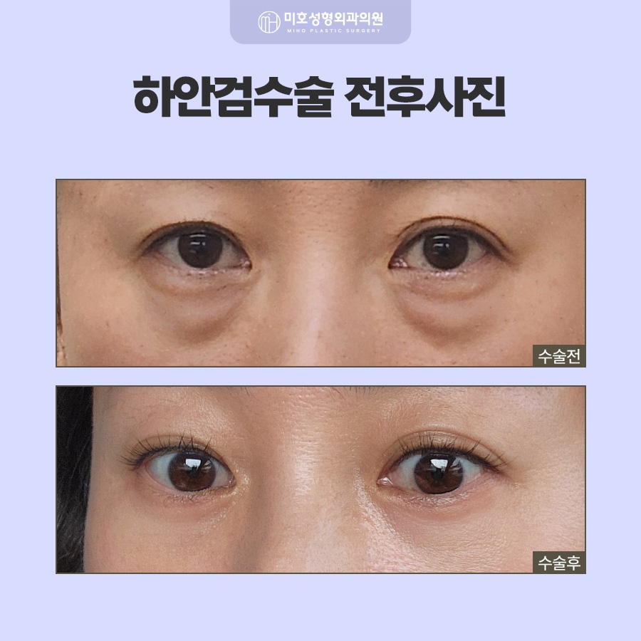하안검수술 아래쪽 변화가 고민이라면 관련 이미지 7