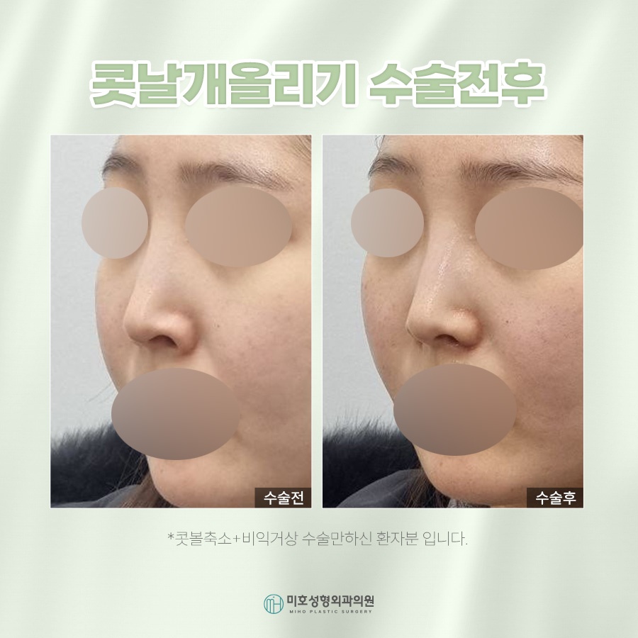 콧날개올리기 처진 코 교정 관련 이미지 10