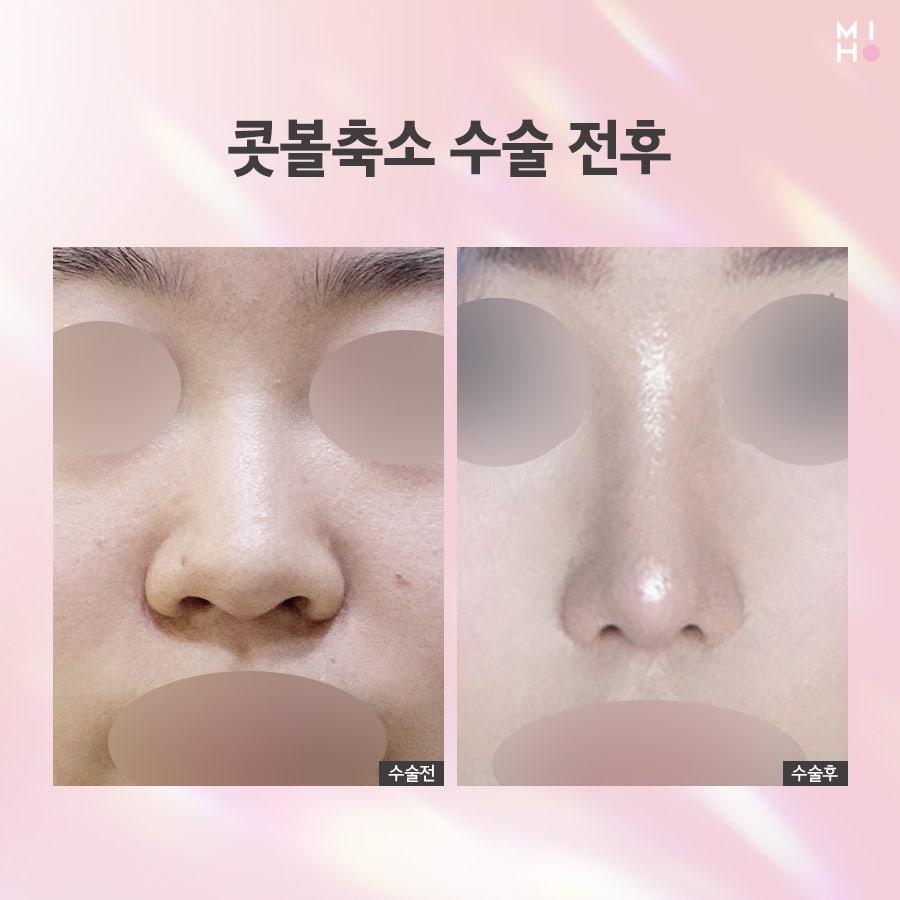 How Alar Reduction Surgery Is Performed and What to Expect in the Future image 24