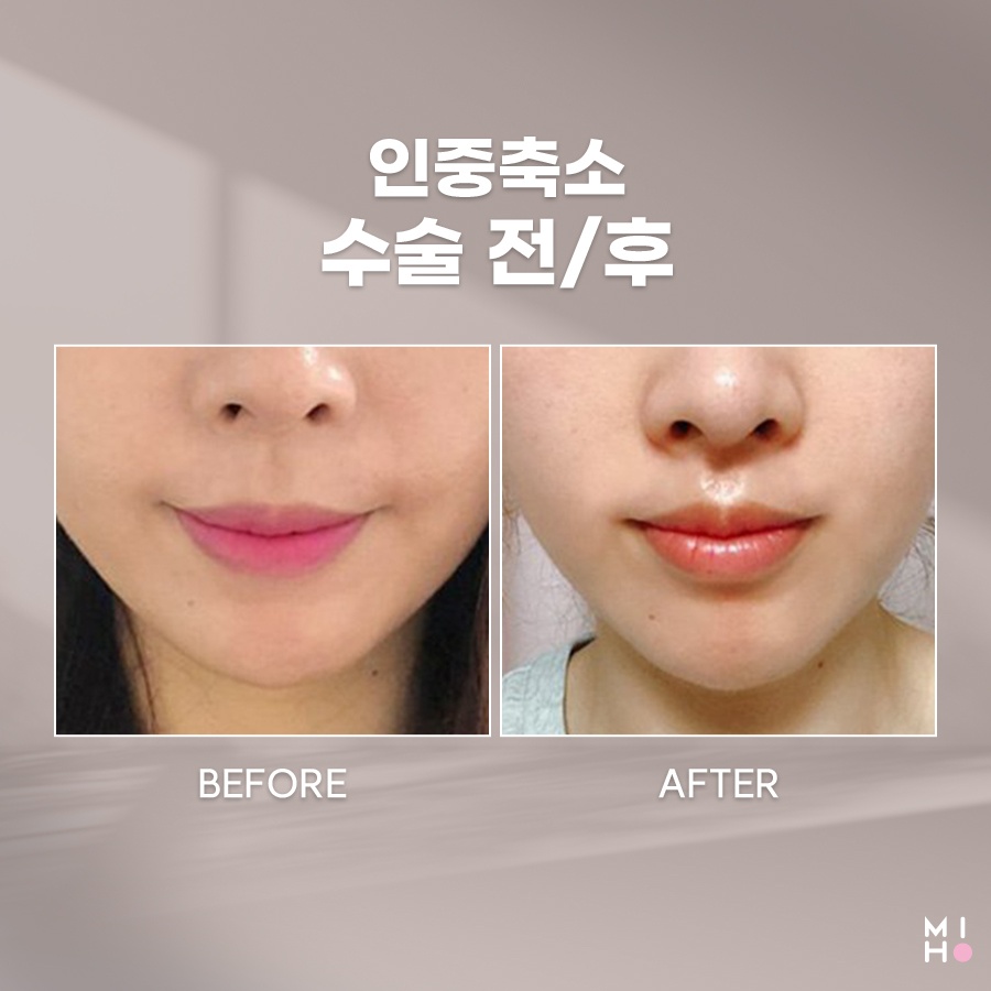 인중축소 중안부 짧은 동안 얼굴로 관련 이미지 10
