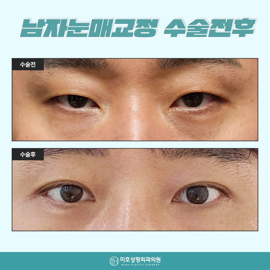 Natural-Looking Male Eye Shape Correction image 7
