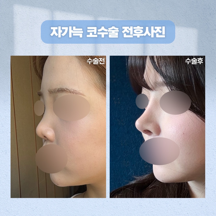 자가늑코수술 재료 특성과 회복 과정 관련 이미지 7