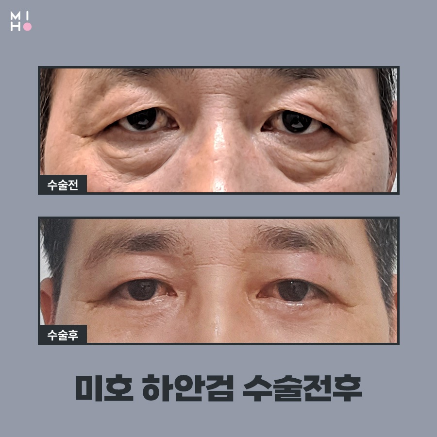 하안검수술 이미지 변신도 안전하게 관련 이미지 7