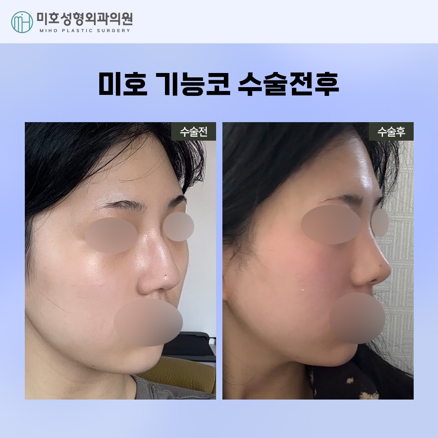 If You Are Looking for Ways to Improve Septal Deviation and Rhinitis Surgery image 9