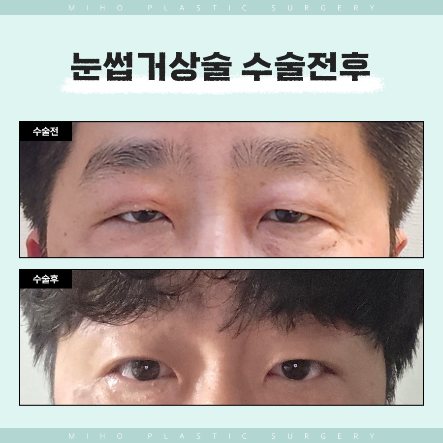 눈썹거상술 인위적이지 않은 변화 관련 이미지 8
