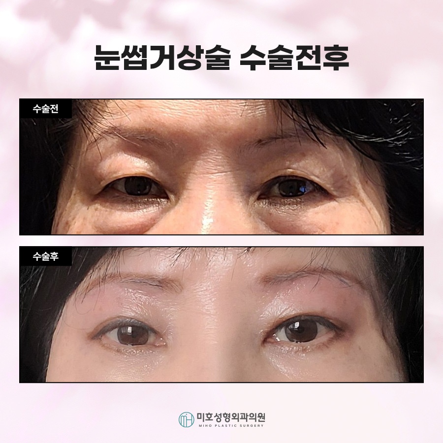 눈썹거상후기 속 주인공이 되는 법 관련 이미지 6