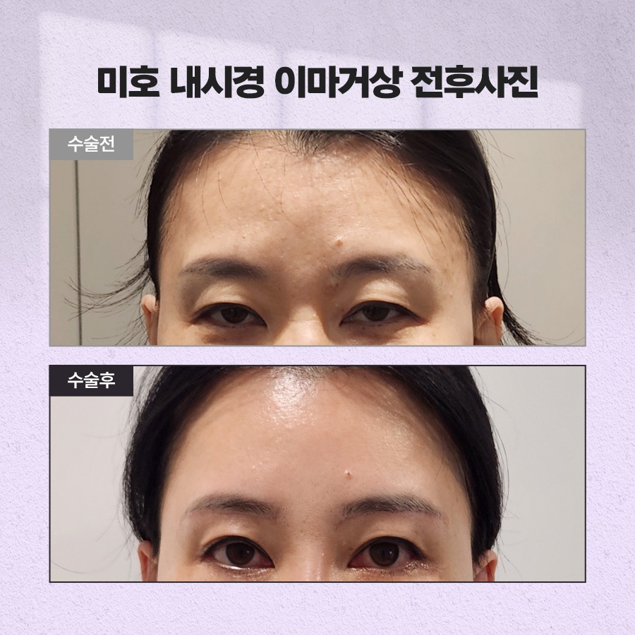 내시경이마거상 처짐 개선 원리 관련 이미지 8