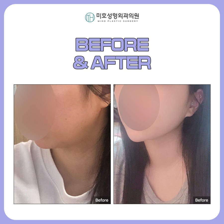 Looking at the Progress of Chin Muscle Ligation for a Double Chin image 10