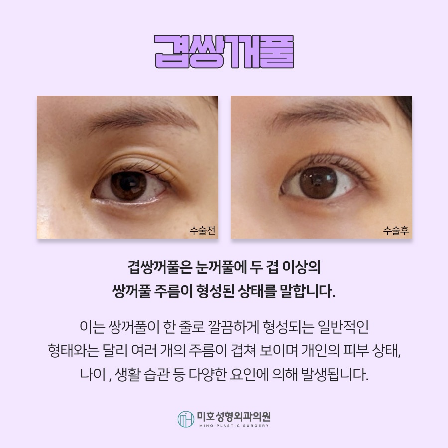 A Clean, Smooth Line for Double Eyelid Folds image 2