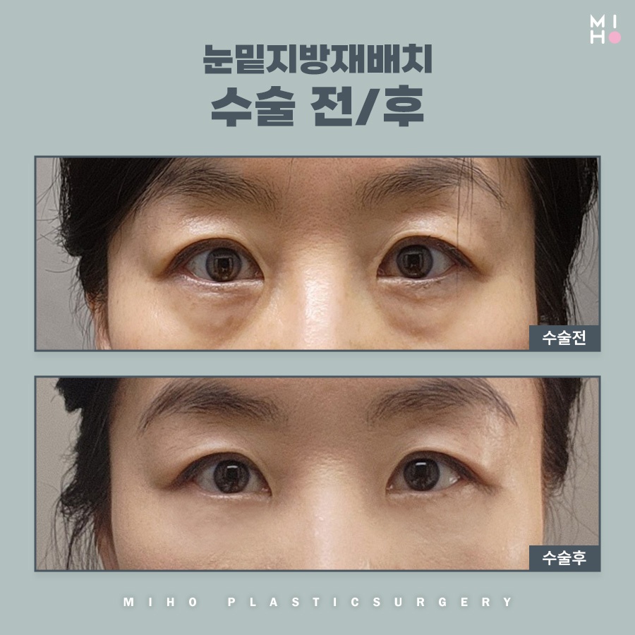 눈밑지방재배치 호감형 인상으로 개선하려면 관련 이미지 10