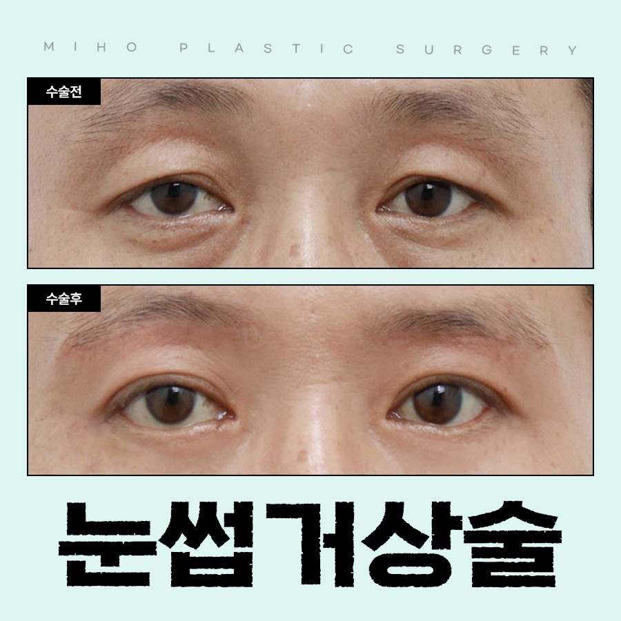 눈썹거상술 인위적이지 않은 변화 관련 이미지 1