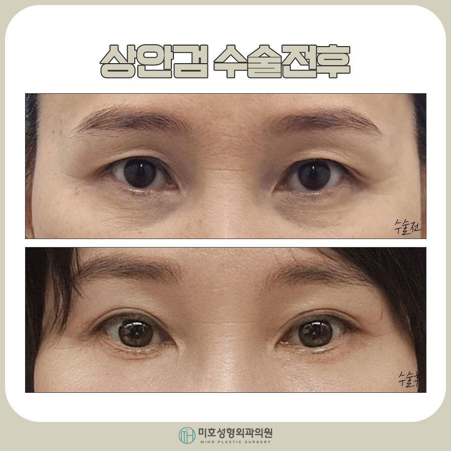 Factors to Consider for Upper Eyelid Surgery Costs image 8