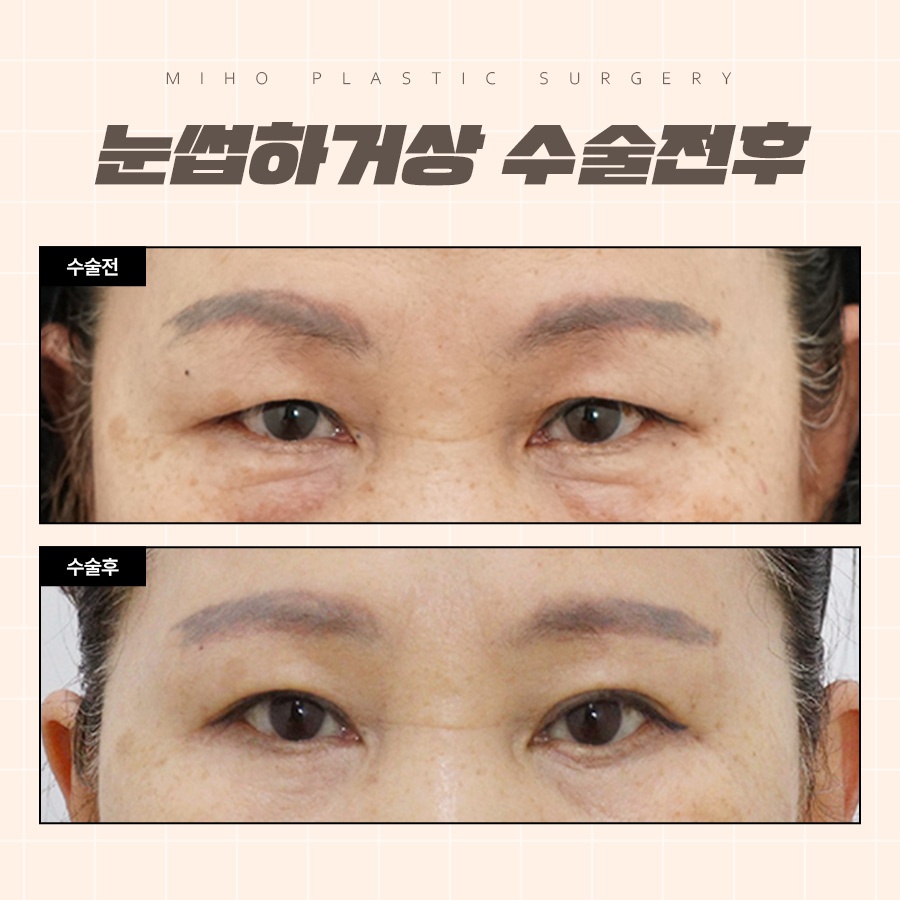 눈썹하거상 처진 눈꺼풀 또렷하게 관련 이미지 7